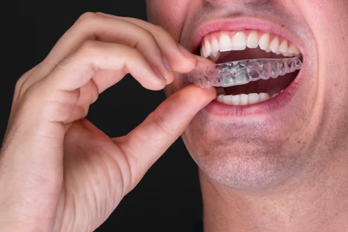 how quickly does invisalign work? insights from patients